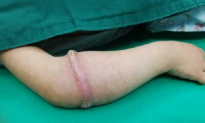 4yo Girl Grows Mysterious Ring of Flesh Around Arm Caused By Ordinary Household Item - WORLD OF BUZZ 6