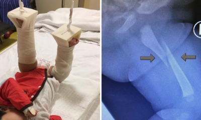 Parents Shocked to Find Their Baby With Broken Thigh Bone While Allegedly Under Babysitter's Care - WORLD OF BUZZ 2