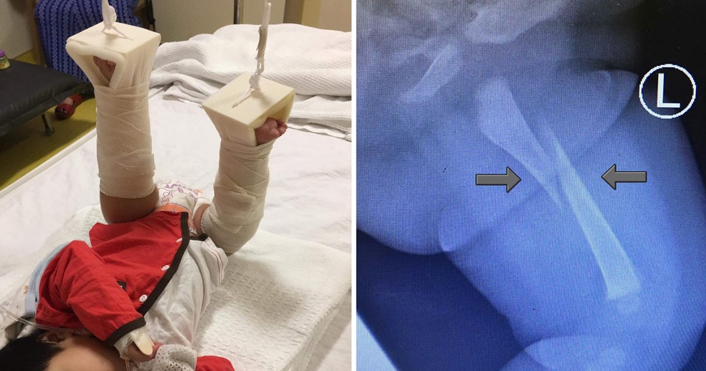 Parents Shocked to Find Their Baby With Broken Thigh Bone While Allegedly Under Babysitter's Care - WORLD OF BUZZ 2