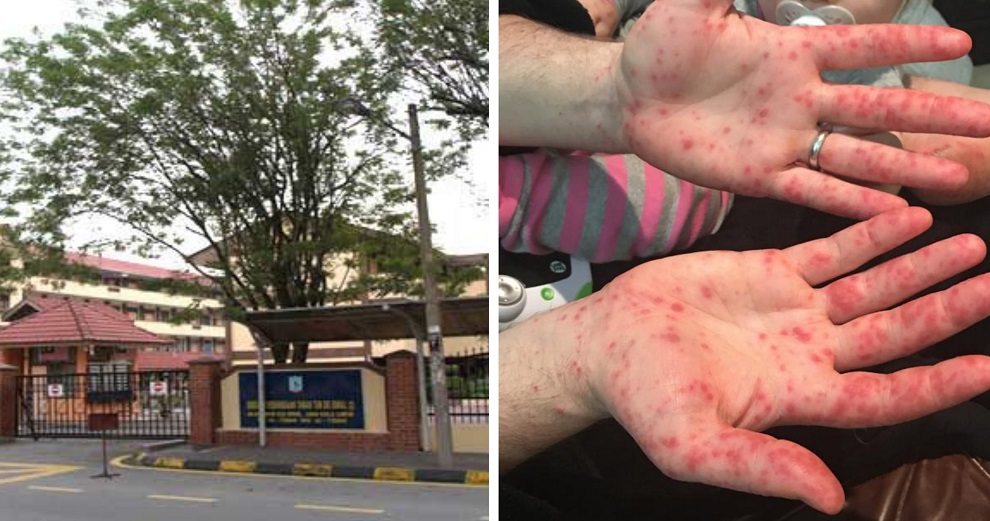 HFMD Cases Reported in TTDI School, Class Ordered Shut - WORLD OF BUZZ 3