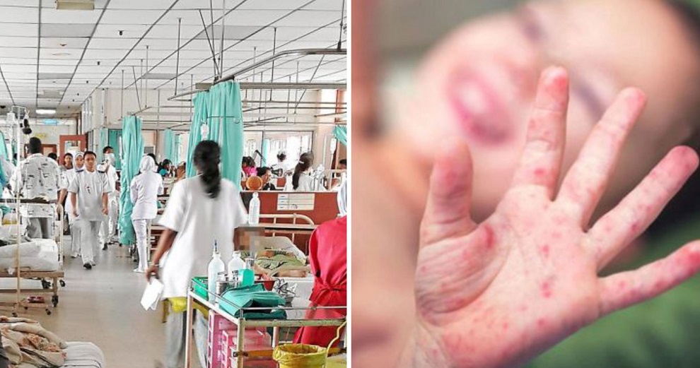 M'sian Toddler First to Die from HFMD Outbreak After Ministry of Health's Public Warning - WORLD OF BUZZ 1