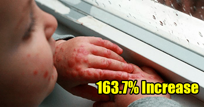 Negri Sembilan Shockingly Reported to Have 163.7 Per Cent Hike in HFMD Cases - WORLD OF BUZZ