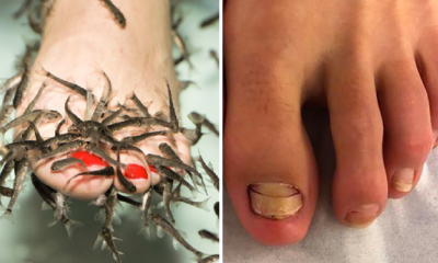 Young Woman Shockingly Loses Her Toenails After Going for Fish Pedicure - WORLD OF BUZZ 4