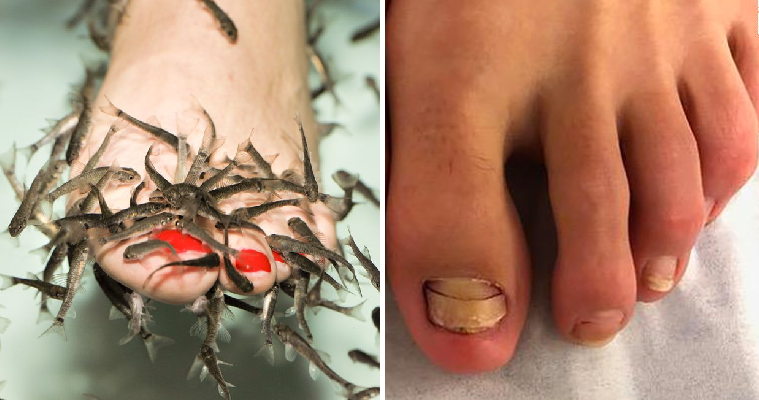 Young Woman Shockingly Loses Her Toenails After Going for Fish Pedicure - WORLD OF BUZZ 4