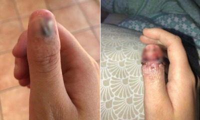 20yo Girl's Bad Habit of Biting Nails Exposed Her Skin to Infections, Now Has Cancer - WORLD OF BUZZ