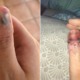 20yo Girl's Bad Habit of Biting Nails Exposed Her Skin to Infections, Now Has Cancer - WORLD OF BUZZ
