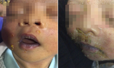 M'sian Baby Contracted Highly Contagious Skin Disease From Infected Visitors at Hospital - WORLD OF BUZZ