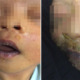 M'sian Baby Contracted Highly Contagious Skin Disease From Infected Visitors at Hospital - WORLD OF BUZZ