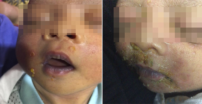 M'sian Baby Contracted Highly Contagious Skin Disease From Infected Visitors at Hospital - WORLD OF BUZZ