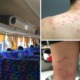 Another Passenger Suffers Severe Bedbug Bites While on StarMart Express Bus to Melaka - WORLD OF BUZZ 5