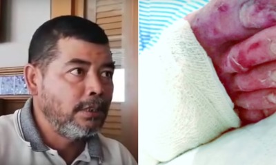 20yo M'sian Suffers Severe Burns After Being Forced to Soak Feet in Hot Water at Military Camp - WORLD OF BUZZ