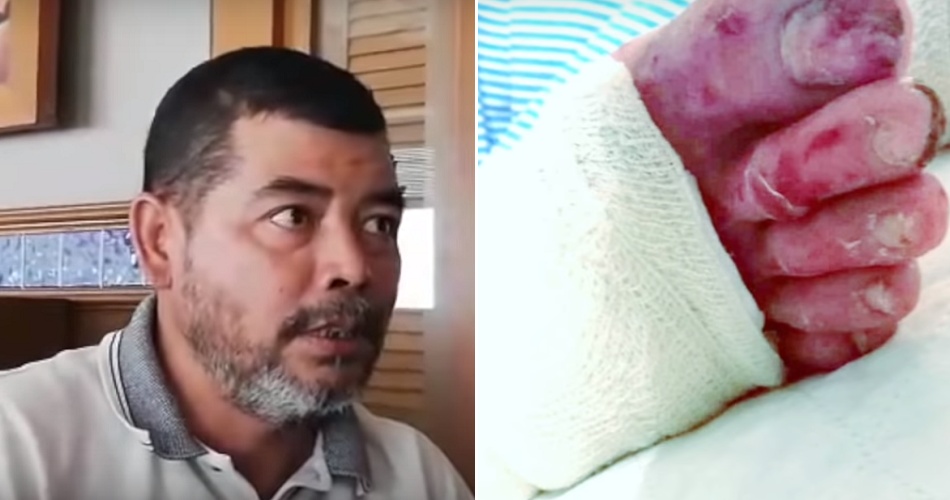 20yo M'sian Suffers Severe Burns After Being Forced to Soak Feet in Hot Water at Military Camp - WORLD OF BUZZ