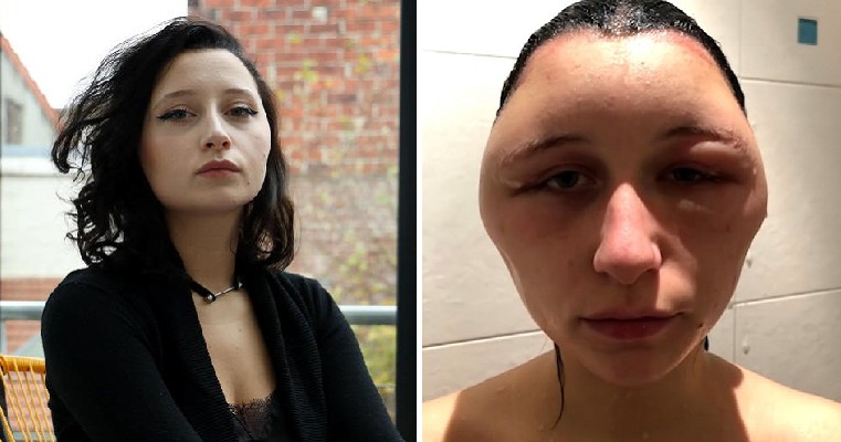 Girl's Head and Tongue Swell Severely Due to Near-Fatal Allergic Reaction to Hair Dye - WORLD OF BUZZ 3