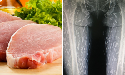 Woman's Love for Eating Raw Meat Causes Her Legs to Be Infected with Parasitic Worms - WORLD OF BUZZ 2