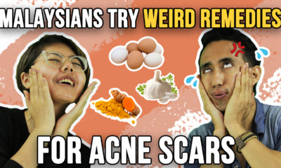 Malaysians Try Weird Remedies For Acne Scars - WORLD OF BUZZ 1