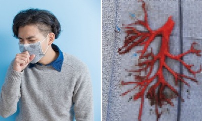 Man with Heart Complications Literally Coughs Up Part of His Lung Before Dying - WORLD OF BUZZ