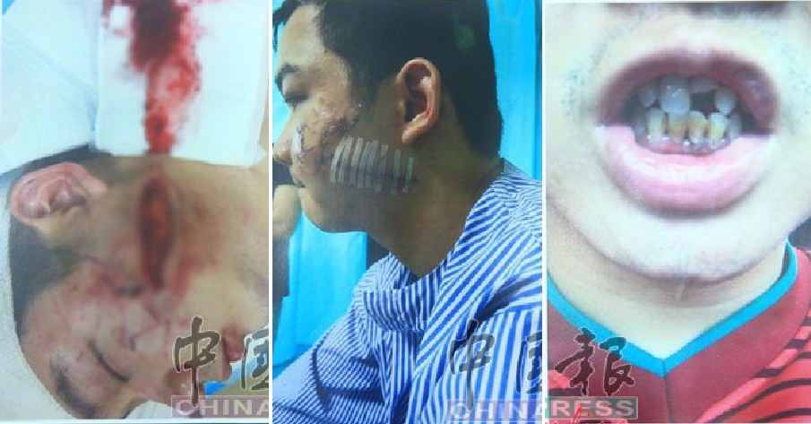 M'sian Man Gets Viciously Beaten Up in Kepong Bar for Saying "If You Can't Drink, Then Go Home" - WORLD OF BUZZ 7