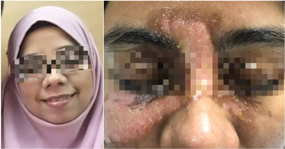 Woman Suffered 2nd And 3rd Degree Burns On Her Face After A Facial Spa Accident, Owner Refused To Be Responsible - WORLD OF BUZZ 3