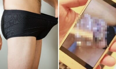 Young Man's Genital Rash and Warts Worsens Into Penile Cancer, Forced to Remove Penis - WORLD OF BUZZ 2