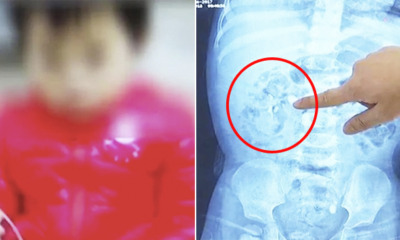 1yo Baby Ends Up With Kidney Stones After Mother Gives Calcium Supplements To Boost Growth - WORLD OF BUZZ