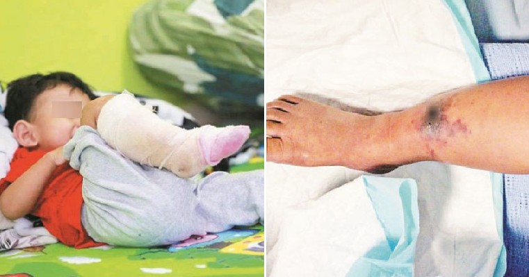 2yo Boy Risks Leg Amputation After Insect Bite on Leg Gets Infected with Flesh-Eating Bacteria - WORLD OF BUZZ 4