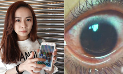 25YO Lady Uses Phone With Maximum Screen Brightness, Cornea Gets Damaged With 500 'Holes' - WORLD OF BUZZ