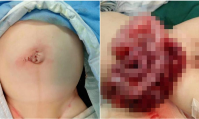 Baby's Intestines Spilled Out Of His Stomach After Father Made A Small Cut To Let Out Gas - WORLD OF BUZZ 4