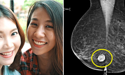 Breast Cancer Survivors Share the 5 Unlikely Symptoms M'sians Must Look Out For - WORLD OF BUZZ 1