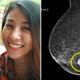 Breast Cancer Survivors Share the 5 Unlikely Symptoms M'sians Must Look Out For - WORLD OF BUZZ 1