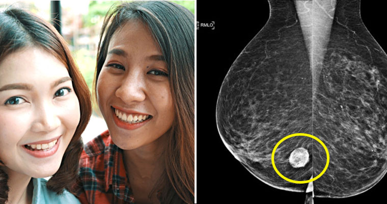 Breast Cancer Survivors Share the 5 Unlikely Symptoms M'sians Must Look Out For - WORLD OF BUZZ 1