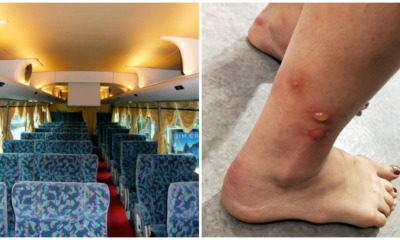 M'sian Woman Takes Bus Ride to Singapore, Gets Blisters and Rashes from Bed Bugs - WORLD OF BUZZ