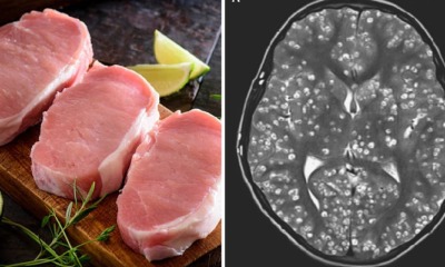 18yo Boy Dies After Parasitic Worms From Eating Undercooked Pork Caused Severe Brain Damage - WORLD OF BUZZ 3