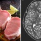18yo Boy Dies After Parasitic Worms From Eating Undercooked Pork Caused Severe Brain Damage - WORLD OF BUZZ 3