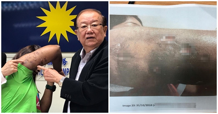 25yo M'sian Woman Gets Fat-Dissolving Injections for Arms, Ends Up with Major Bacterial Infection and Scars - WORLD OF BUZZ 6