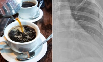 30yo Woman Who Drinks Over 10 Cups of Coffee Daily Finds Out Her Bones Are Like A 60yo - WORLD OF BUZZ 1
