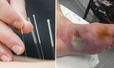 Diabetic Man Loses Leg After Using Traditional Chinese Medicine, Unsympathetic Practitioner Suspended - WORLD OF BUZZ 3