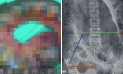 Man Had to Remove Parts of Intestines Because He Suffered From Constipation for 1 Week - WORLD OF BUZZ 1