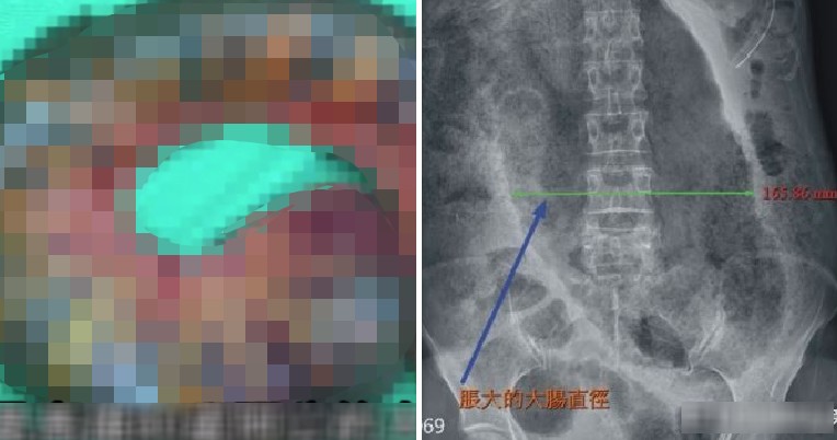 Man Had to Remove Parts of Intestines Because He Suffered From Constipation for 1 Week - WORLD OF BUZZ 1