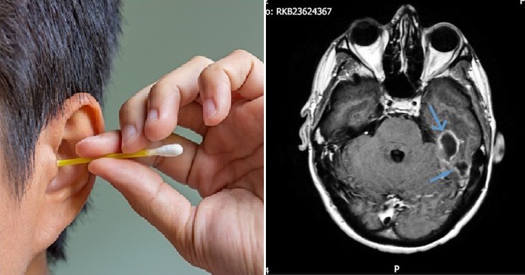 Man Suffers From Potentially Deadly Brain Infection After He Used Cotton Bud to Clean His Ears - WORLD OF BUZZ 5