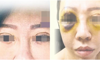 This Woman Had A Double Eyelid Surgery in a Cheras Beauty Salon and Now Her Right Eyeball is Damaged - WORLD OF BUZZ