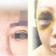 This Woman Had A Double Eyelid Surgery in a Cheras Beauty Salon and Now Her Right Eyeball is Damaged - WORLD OF BUZZ