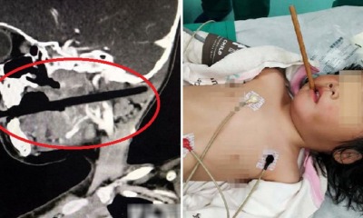 3yo Girl Gets Chopstick Pierced Through Her Skull As She Was Playing While Eating - WORLD OF BUZZ 2