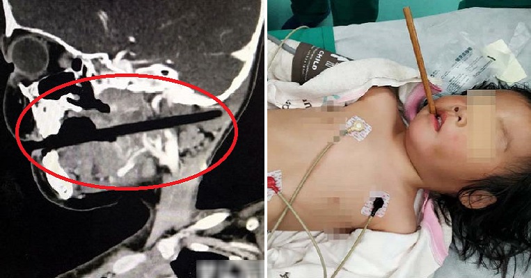3yo Girl Gets Chopstick Pierced Through Her Skull As She Was Playing While Eating - WORLD OF BUZZ 2