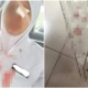 Johor Nurse Suffered Childhood Phobia IRL When An Old Fan Blade Fell and Injured Her - WORLD OF BUZZ 1