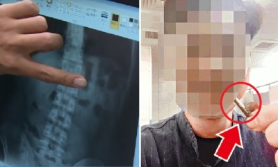 Man Swallows AirPod While Sleeping, Still Able to Use It After Pooping It Out - WORLD OF BUZZ 3