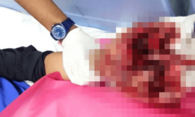 13yo Malaysian Boy Loses All 5 Fingers While Playing With Firecrackers During Ramadan - WORLD OF BUZZ 2