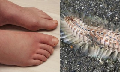 36yo Man's Left Leg Paralysed For Life After He Was Stung By a Golden Fireworm in Pangkor - WORLD OF BUZZ 2