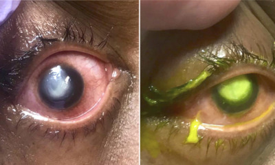 Doctor Shares How Woman's Cornea Gets Eaten Away By Bacteria After Sleeping In Contact Lenses - WORLD OF BUZZ