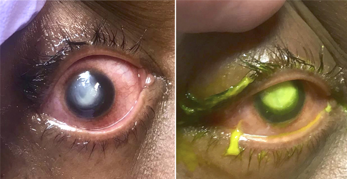 Doctor Shares How Woman's Cornea Gets Eaten Away By Bacteria After Sleeping In Contact Lenses - WORLD OF BUZZ