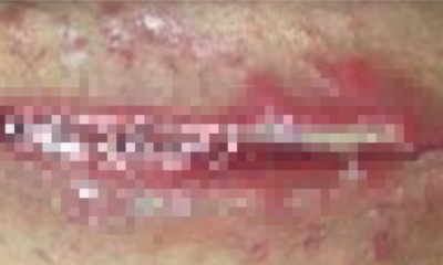 Lady Treats Her Caesarean Would With Turmeric And It Gets Severely Infected - WORLD OF BUZZ 2